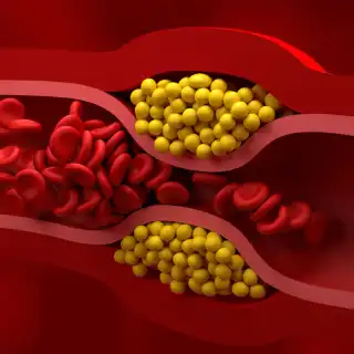 L'excès de cholestérol&nbsp;peut contribuer à l’accumulation de graisses dans les artères, augmentant ainsi le risque de problèmes cardiovasculaires. ©&nbsp;&nbsp;Superrider, Adobe Stock