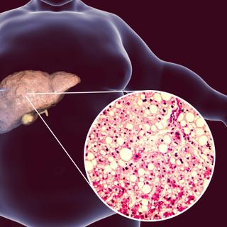 Esteatose hepática em homem obeso. © Kateryna_Kon, Adobe Stock