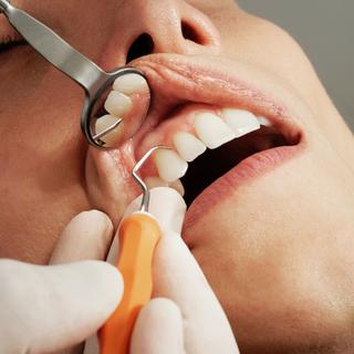 Les maladies des gencives et la perte de dents pourraient&nbsp;jouer un rôle dans le déclin cognitif.&nbsp;© Caroline LM, Unsplash