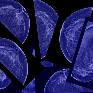 La mammographie détecterait trop de petites tumeurs sans danger. © flik47, Fotolia