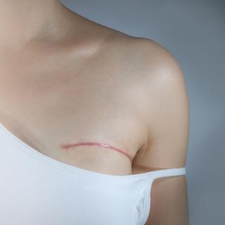 Após uma mastectomia, 30% das mulheres são submetidas à reconstrução mamária. © Pradit, Adobe Stock