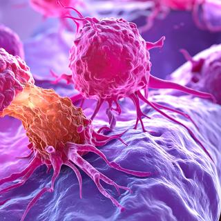 Metástases: quando o câncer se espalha e muda a situação. ©Sam Adobe Stock