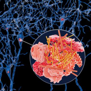 Moins connue que les maladies d’Alzheimer ou de Parkinson, la maladie à&nbsp;corps de Lewy&nbsp;touche pourtant plus&nbsp;de 200 000 personnes en France. ©&nbsp;Juan Gärtner, Adobe Stock