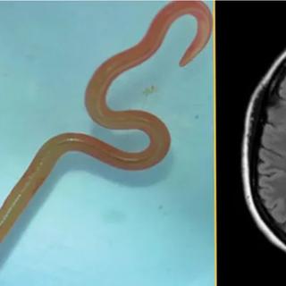  un parasite inédit identifié chez une patiente après des mois d’errance diagnostique. ©&nbsp;Hossain, M., Kennedy, K. J., Wilson, H. L., Spratt, D., Koehler, A., Gasser, R. B....Senanayake, S. N. (2023). Human Neural Larva Migrans Caused by Ophidascaris robertsi Ascarid. Emerging Infectious Diseases, 29(9), 1900-1903.