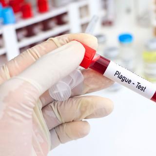  une infection disparue depuis huit ans détectée chez un patient ! ©&nbsp;Kittisak Kaewchalun, iStock