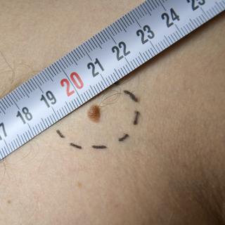 Uma verruga que muda de cor ou formato pode ser um sinal de melanoma. © Fotolia