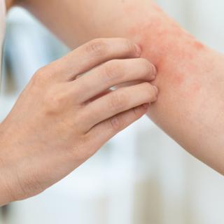 Reconhecer uma reação alérgica cutânea é essencial para tomar as medidas adequadas e aliviar os sintomas. © Pormezz, Adobe Stock