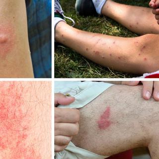 elfbar nachfüll pod läuft aus Urticaire allergique : symptômes, photos, analyse par IA 🚨 CIM-10 : L50 main image 1