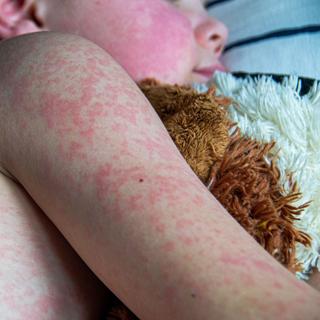 La maladie a entraîné des hospitalisations pour près d'un tiers des cas (144), surtout des enfants de moins de cinq ans et des adultes de plus de 30 ans. ©&nbsp;Povorozniuk Liudmyla, Getty Images