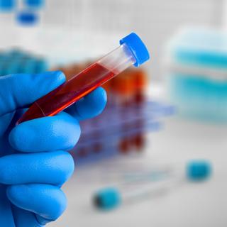 Os exames de sangue mostram sua comprovação na detecção precoce do câncer. © BillionPhotos.com, Adobe Stock