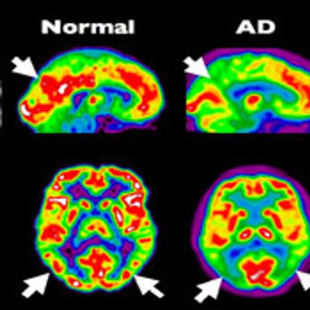 Tomographie par émission de positons (PET Scan en anglais) d’un cerveau en bonne&amp;nbsp;santé en comparaison avec un cerveau atteint d’Alzheimer à un stade précoce. © Institut Douglas, Flickr, cc&amp;nbsp;by nc sa 2.0