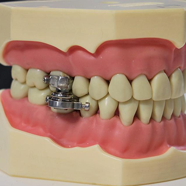 Le dispositif DentalSlim Diet Control empêche la bouche de s’ouvrir de plus de deux millimètres. © Université d'Otago