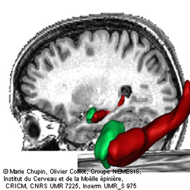 L’hippocampe est l’une des régions du cerveau les plus précocement atteintes par la maladie d’Alzheimer. L’imagerie par résonance magnétique (IRM) permet de visualiser et de délimiter cette structure in vivo. © Inserm