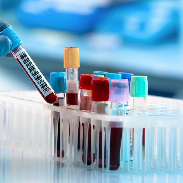 Grâce aux travaux de chercheurs de l’université de Washington (États-Unis), le rêve d’un test sanguin permettant de dépister la maladie d’Alzheimer jusqu’à 20 ans avant que les premiers symptômes se déclarent pourrait bientôt devenir réalité. © angellodeco, Fotolia