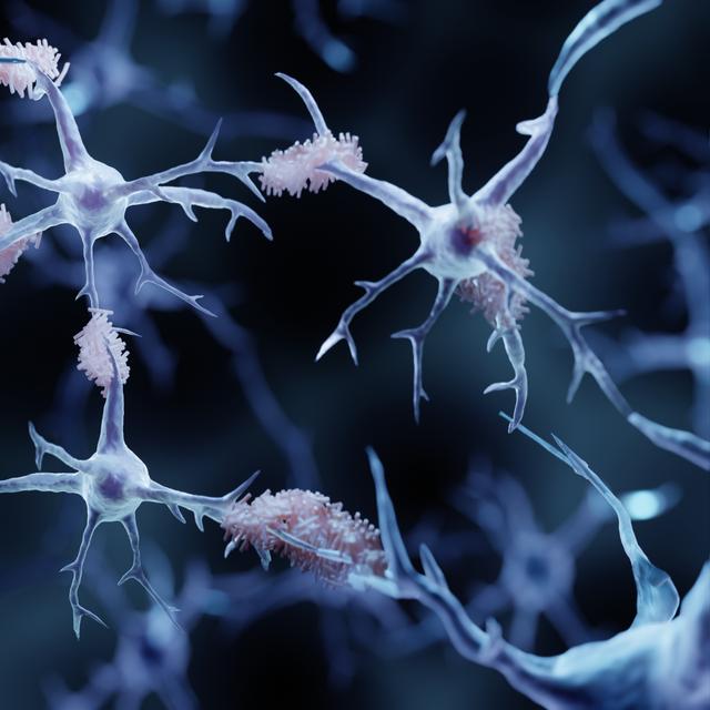 La maladie d'Alzheimer, la plus fréquente des démences,&nbsp;entraîne&nbsp;des troubles de la mémoire récente, des fonctions exécutives et de l’orientation dans le temps et l’espace. © Artur, Adobe Stock