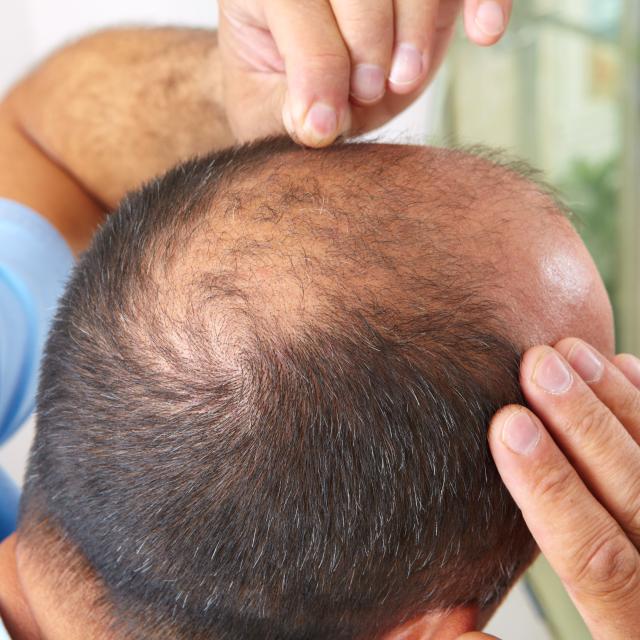 Découvrez quelles sont les techniques de greffe capillaire © Petrik, Adobe Stock