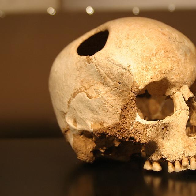 Crâne de jeune fille trépané au silex, Néolithique (3500 Av. JC).&amp;nbsp;© Rama -&amp;nbsp;CC BY-SA 2.0 FR