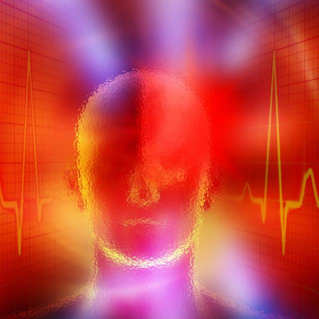 AVC accident vasculaire cérébral. © FS -&nbsp;CC BY-NC 2.0