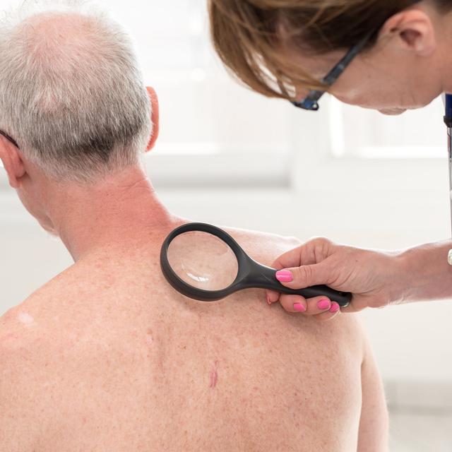 Les effets secondaires des traitements sur la peau affectent&amp;nbsp;la qualité de vie de 93 % des malades. © Thodonal88, Shutterstock