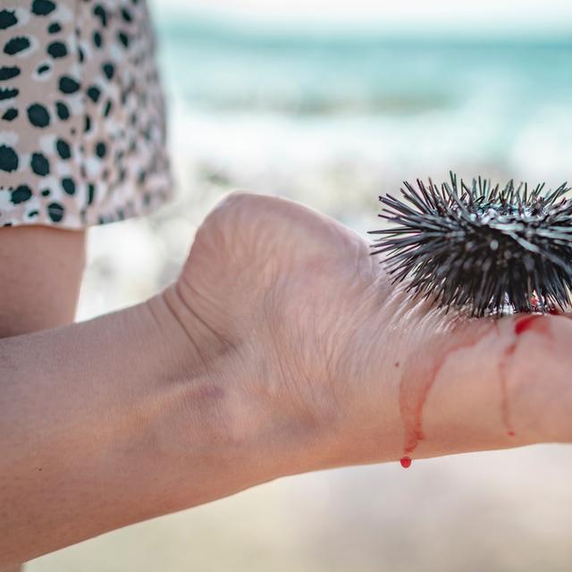 Poser le pied sur un oursin fait très mal. Et soigner la blessure est tout autant douloureux.&nbsp;©&nbsp;Anselm, Adobe Stock