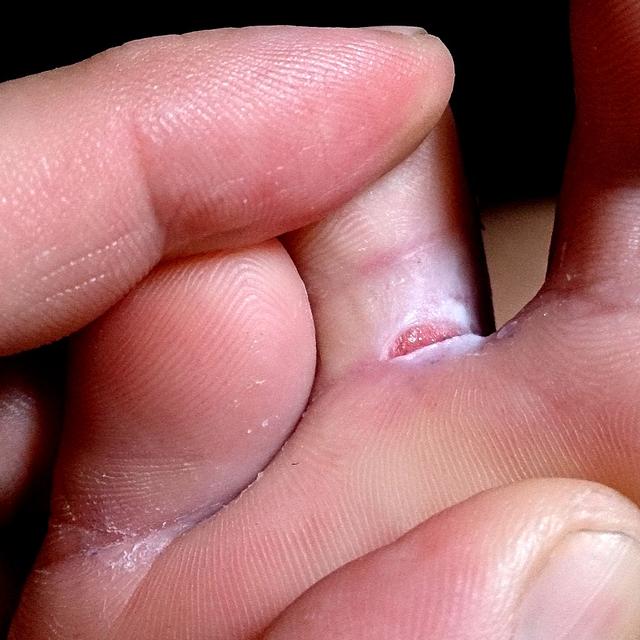 Symptômes et traitements de la mycose des pieds. © ProjectManhattan,&amp;nbsp;Wikimedia commons, CC by-sa&amp;nbsp;3.0