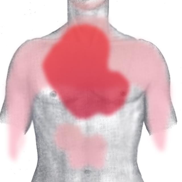 L&#39;infarctus peut se manifester par un grand nombre de symptômes différents. © JHeuser, Wikimedia, CC by-sa 3.0 