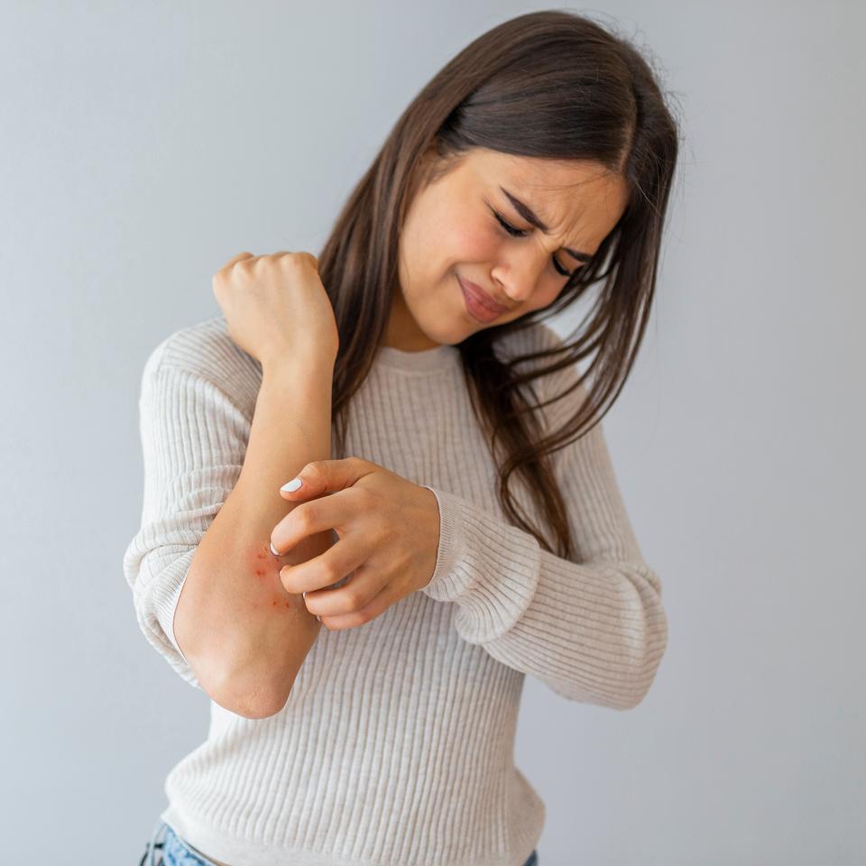 Une maladie inflammatoire de la peau serait en progression dans le monde entier, surtout dans les pays riches. © Dragana Gordic, Adobe Stock