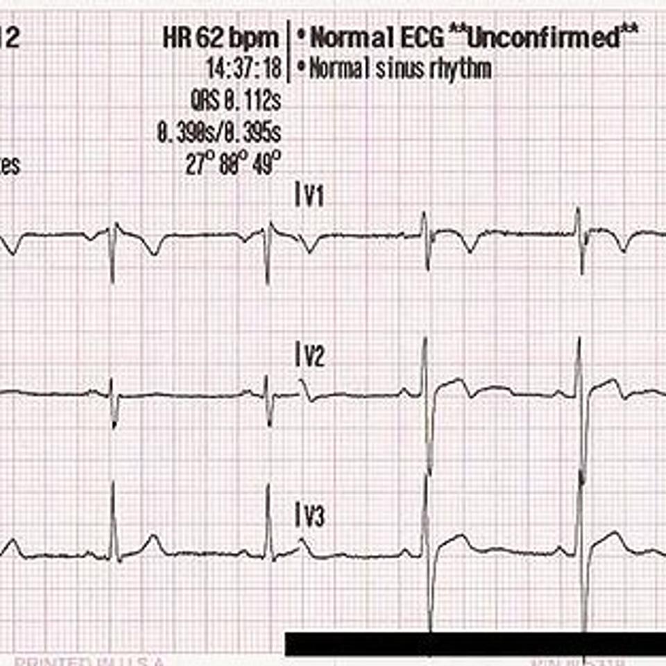 Définition | Variabilité de la fréquence cardiaque : qu'est-ce que c ...