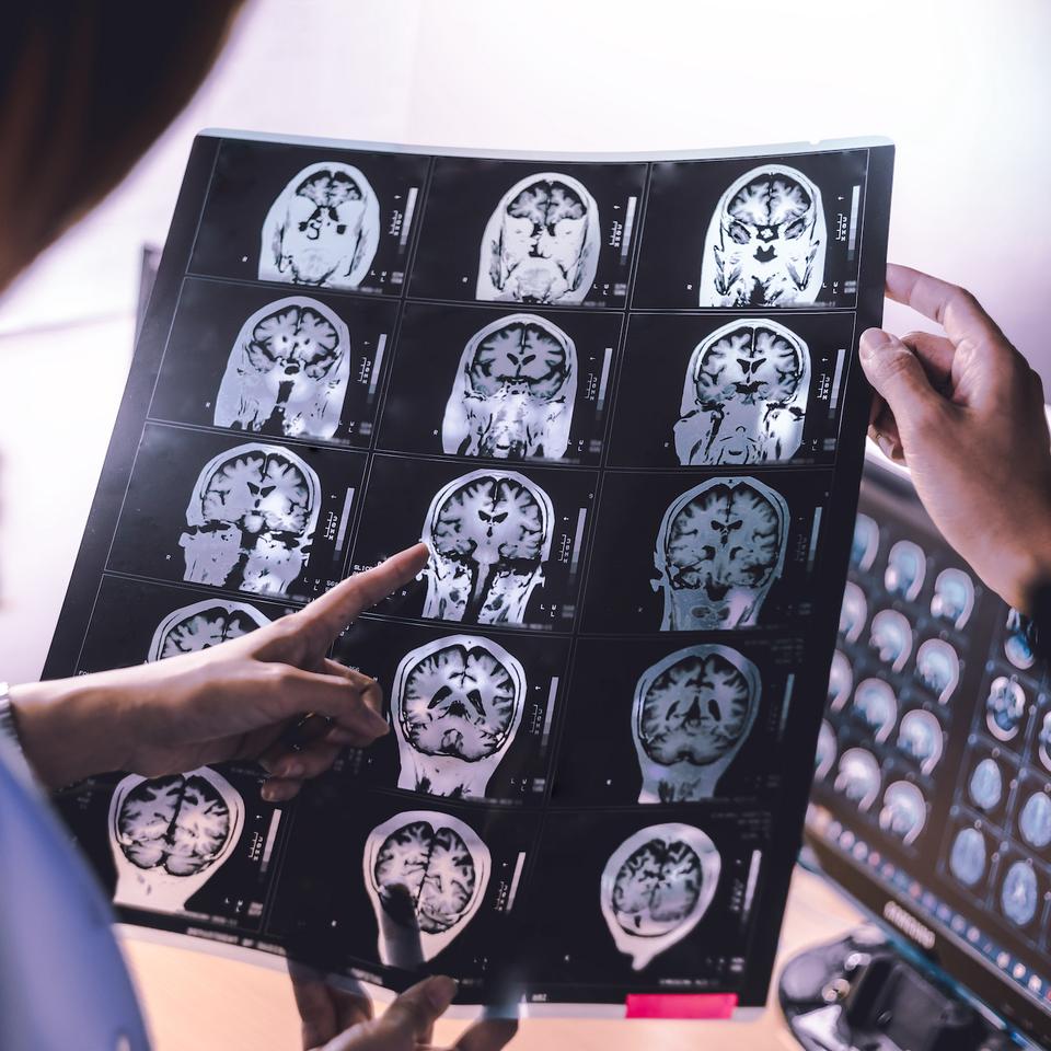 Longtemps considérée comme irréversible, la maladie d’Alzheimer pourrait devoir être repensée. Une étude récente explore une piste inattendue qui redonne espoir quant à la capacité du cerveau à se réparer.&nbsp;© Atthapon, Adobe Stock
