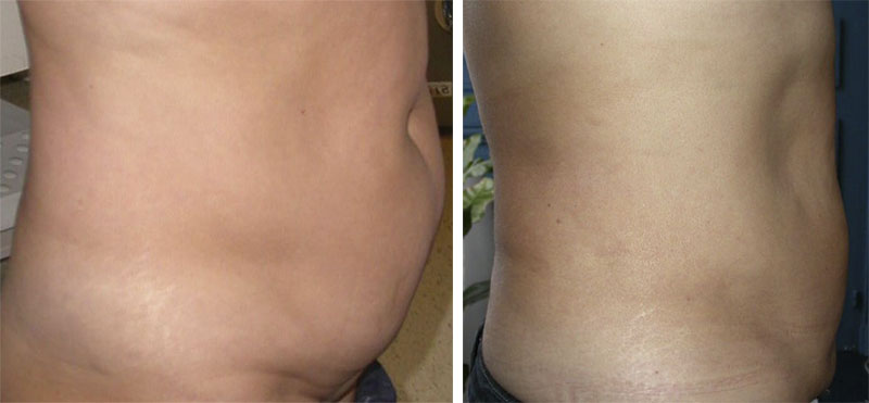 Tout savoir sur la liposuccion, par le Dr Mitz